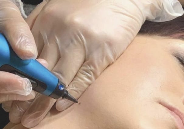 Cryotherapy is used to treat all sorts of skin disorders at our practice in waterloo kitchener area.
