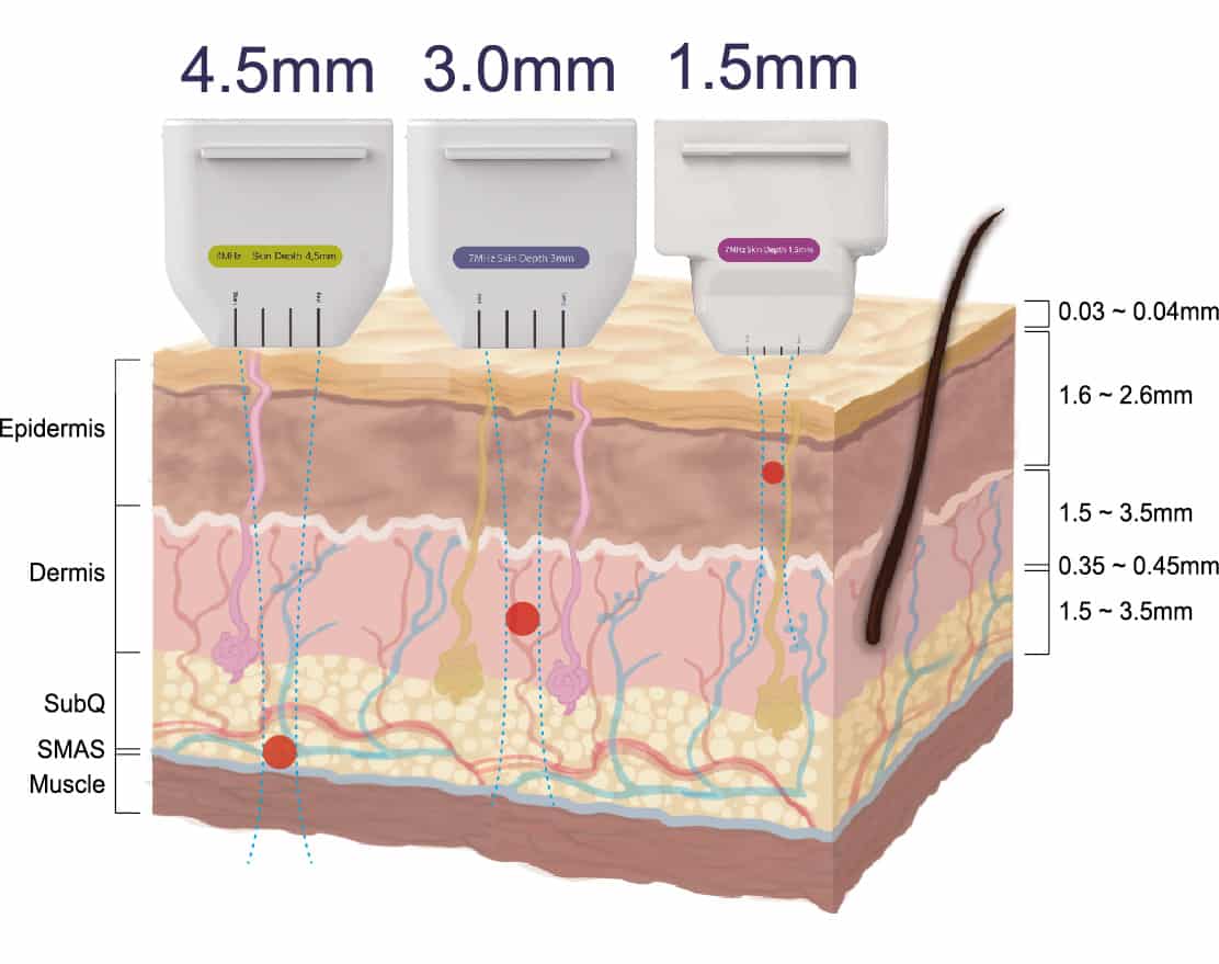 Ultherapy is the only FDA approved non-surgical procedure for SMAS lifting. We are the only Ultherapy authorized provider in the city of Waterloo as of this written. Contact us today for your skin tightening or facelift needs.