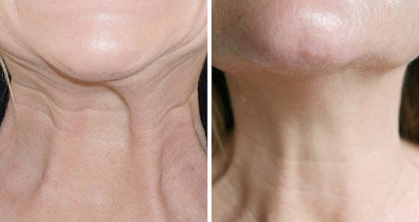 Botox Nefertiti Lift