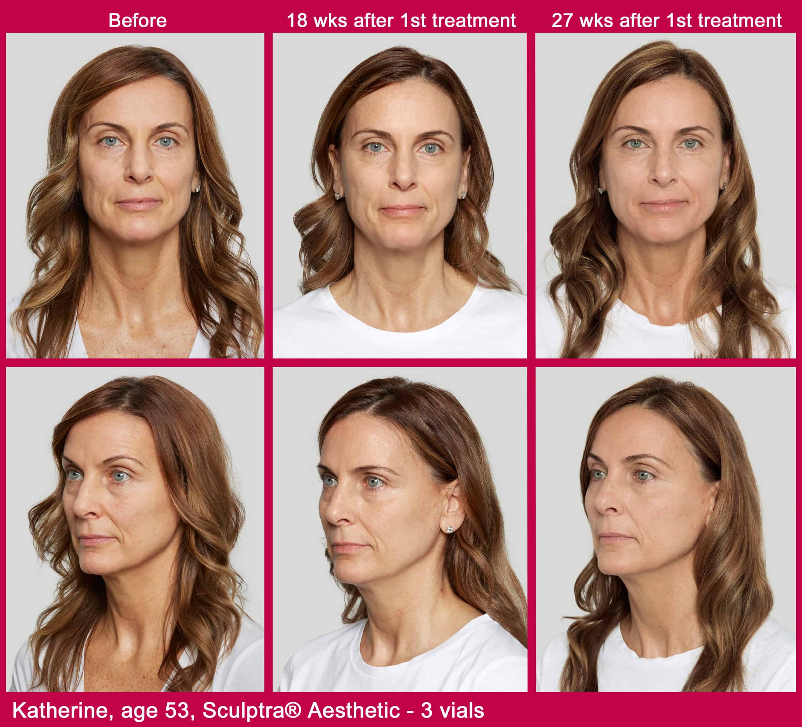Sculptra before and after photos