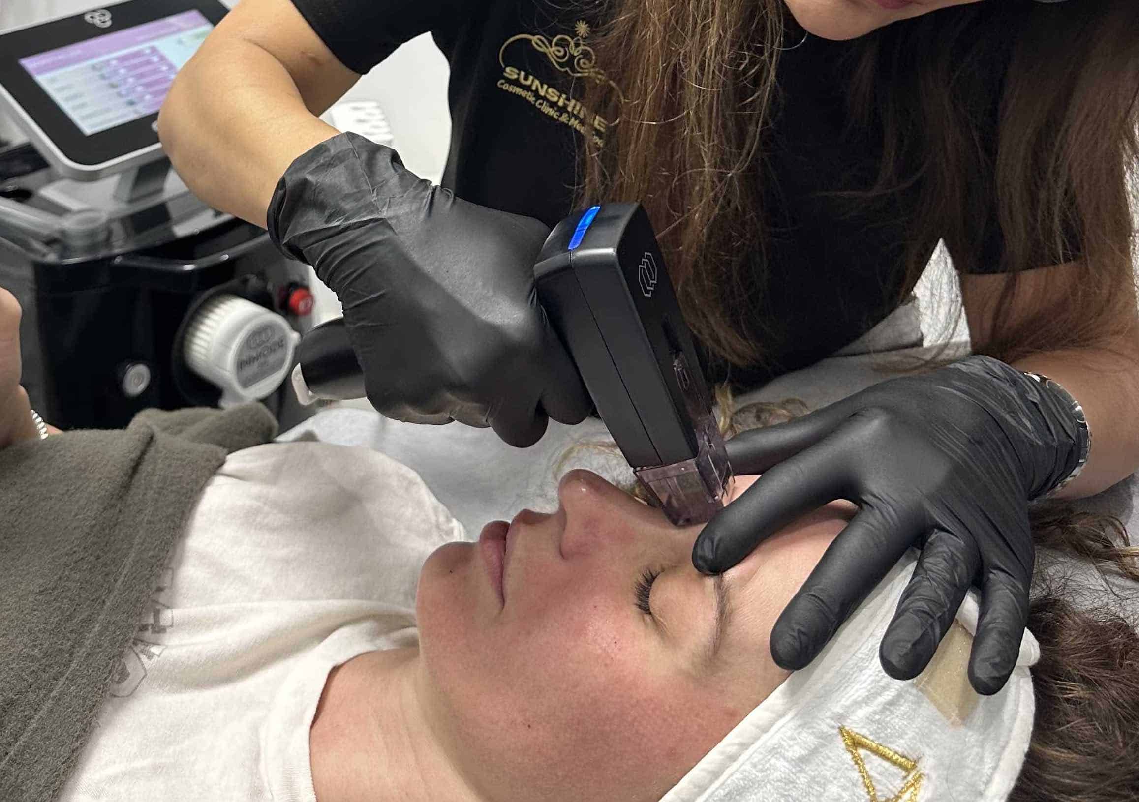 Morpheus8 treatment in progress at Sunshine Cosmetic Clinic & Medi Spa in Kitchener Waterloo