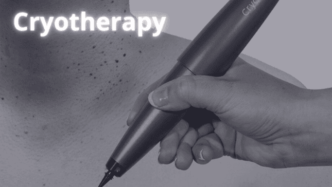cryotherapy for men in kitchener waterloo area
