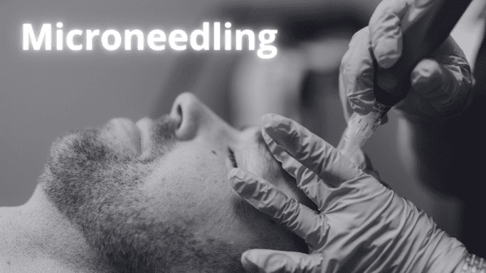 microneedling for men in kitchener waterloo area