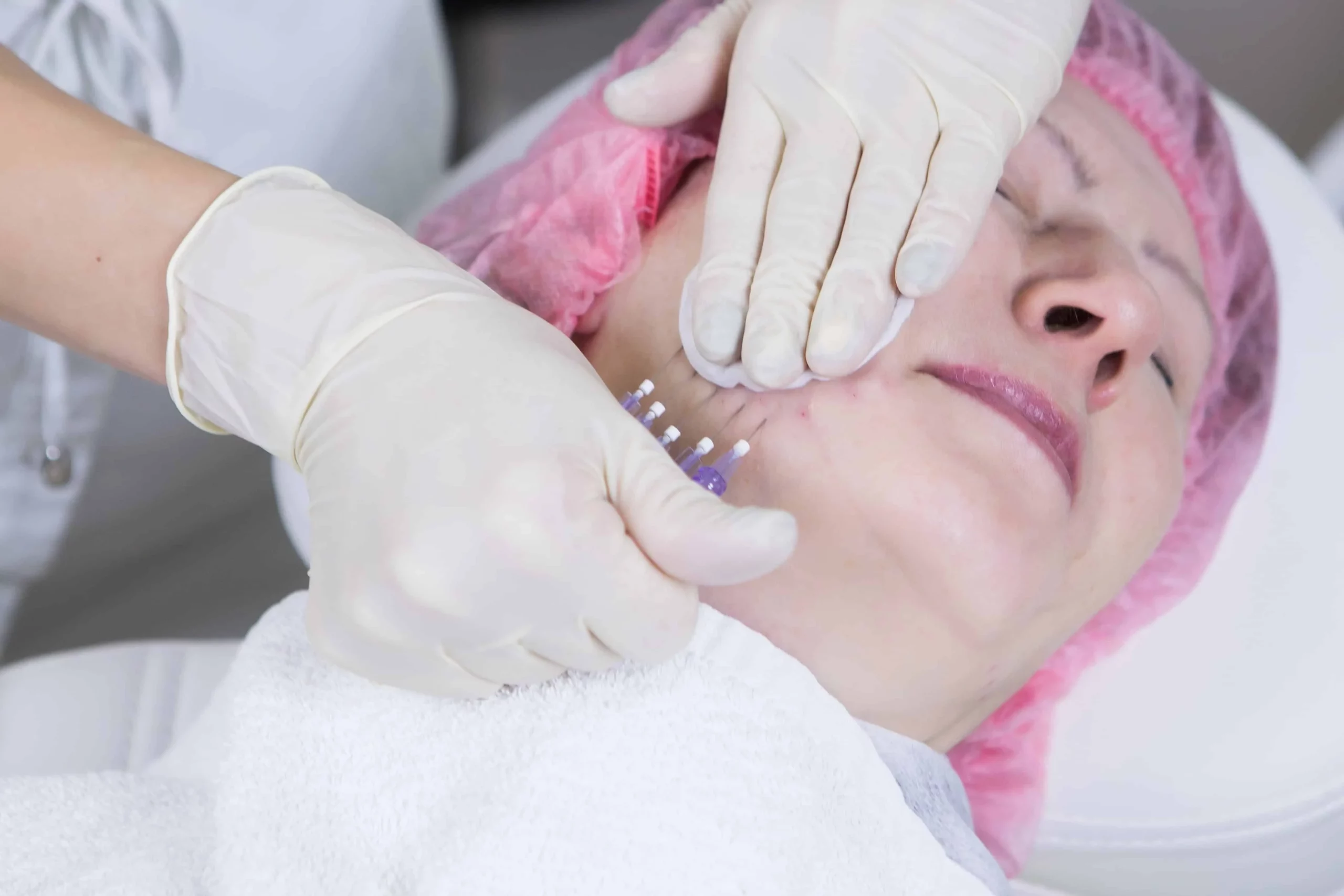The Benefits and Risks of PDO Thread Lifts: What You Need to Know