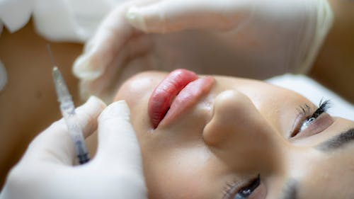 Lip Filler Kitchener – Enhance Natural Beauty with Fuller, Balanced Lips | Waterloo, ON | Sunshine Cosmetic Clinic & Medi Spa